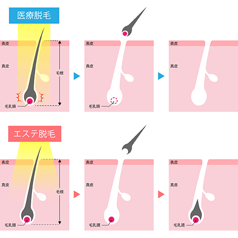 医療脱毛と脱毛サロンの違い