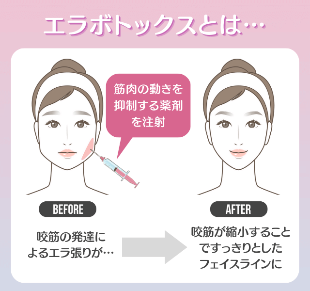 エラボトックスの効果は?どんな人におすすめ?