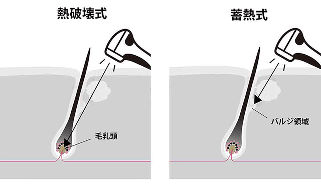 医療脱毛の仕組み