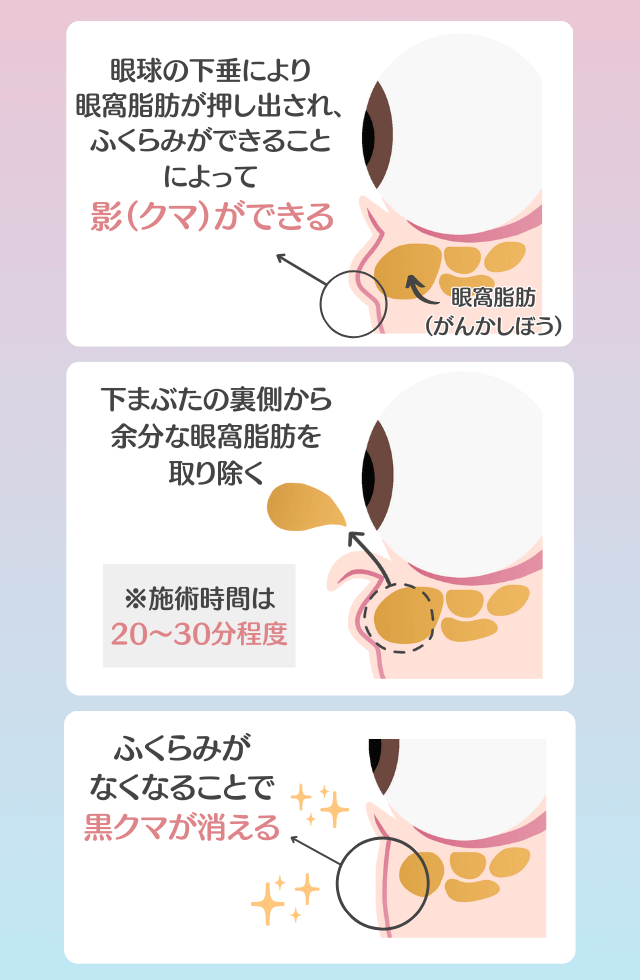 脱脂法(切らないクマ取り)
