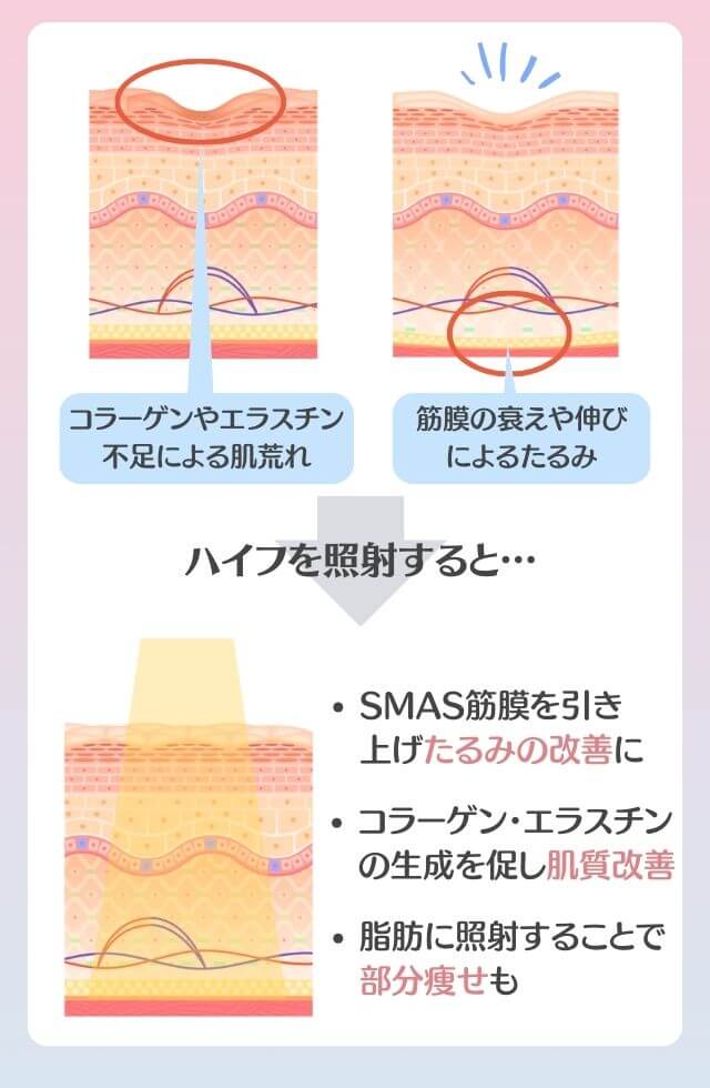 医療ハイフってどんな施術?