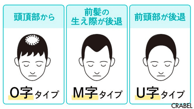 AGAの症状